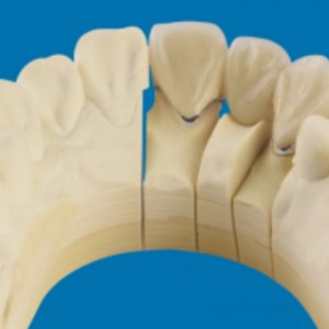 Kov-porcelánové zuby